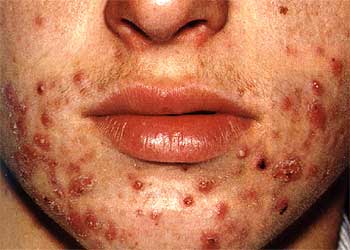 Asian medicine and facial acne