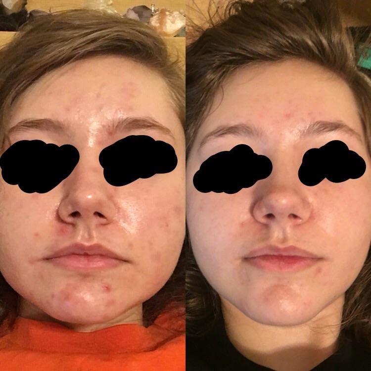 Reno reccomend Asian medicine and facial acne